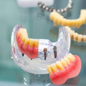 Dental Implants