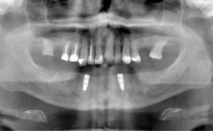 Dental Stabilisation