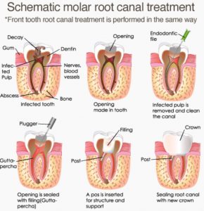 Root Canal Treatment