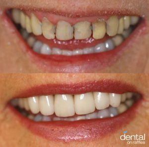 Veneers