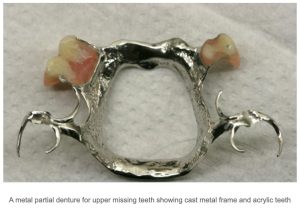Metal Denture